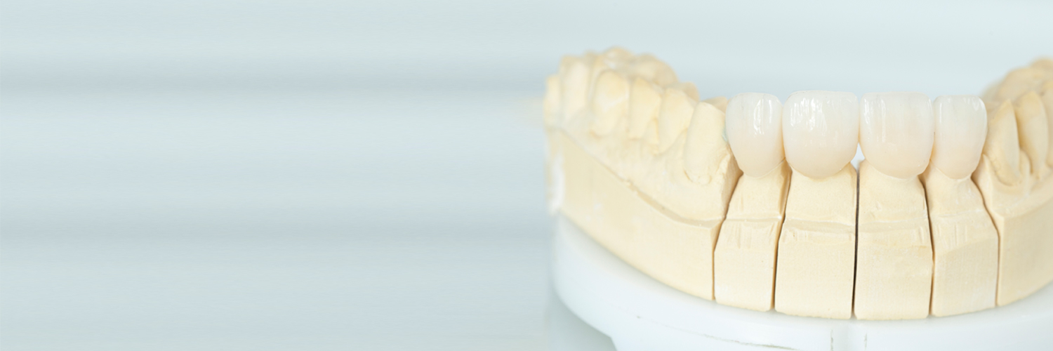 Veneers Modell