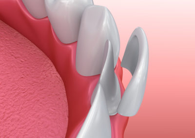 3D Illustration eines Zahn Veneers