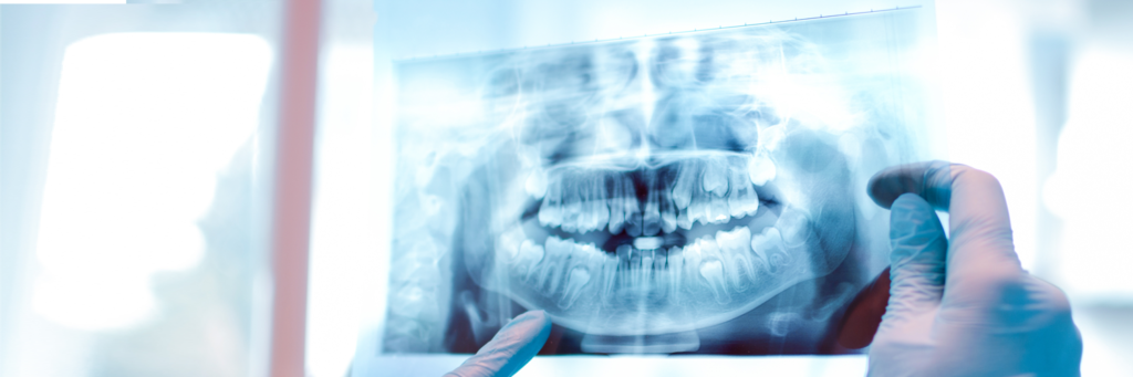 Komplexe Zahnsanierungen - Röntgenaufnahme